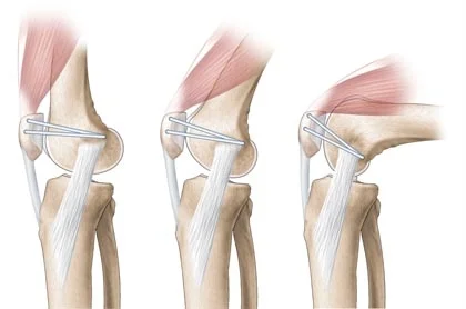 Patella stabilization surgery recovery time new arrivals